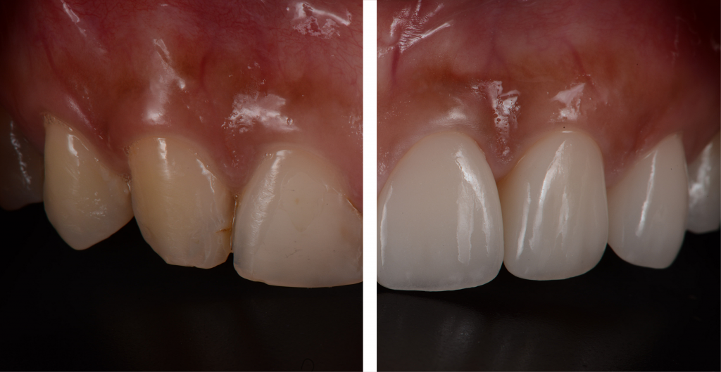 A before and after of a smile makeover