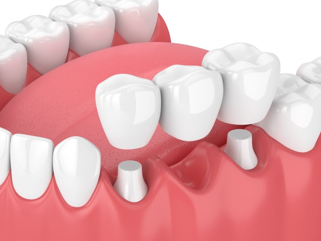 A 3D rendering of a traditional dental bridge
