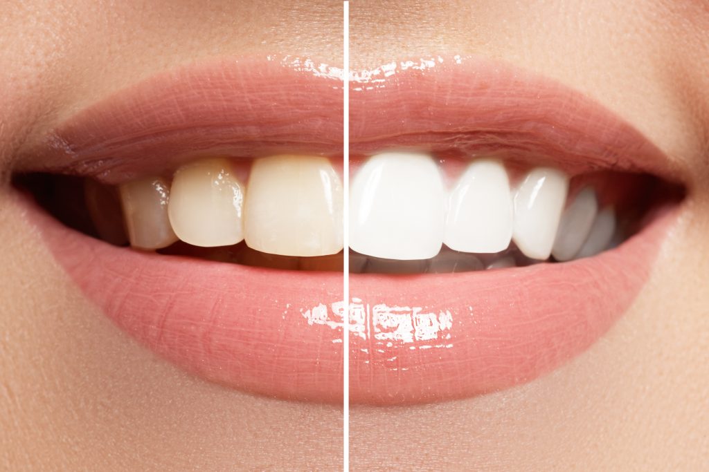 A before and after image for teeth whitening