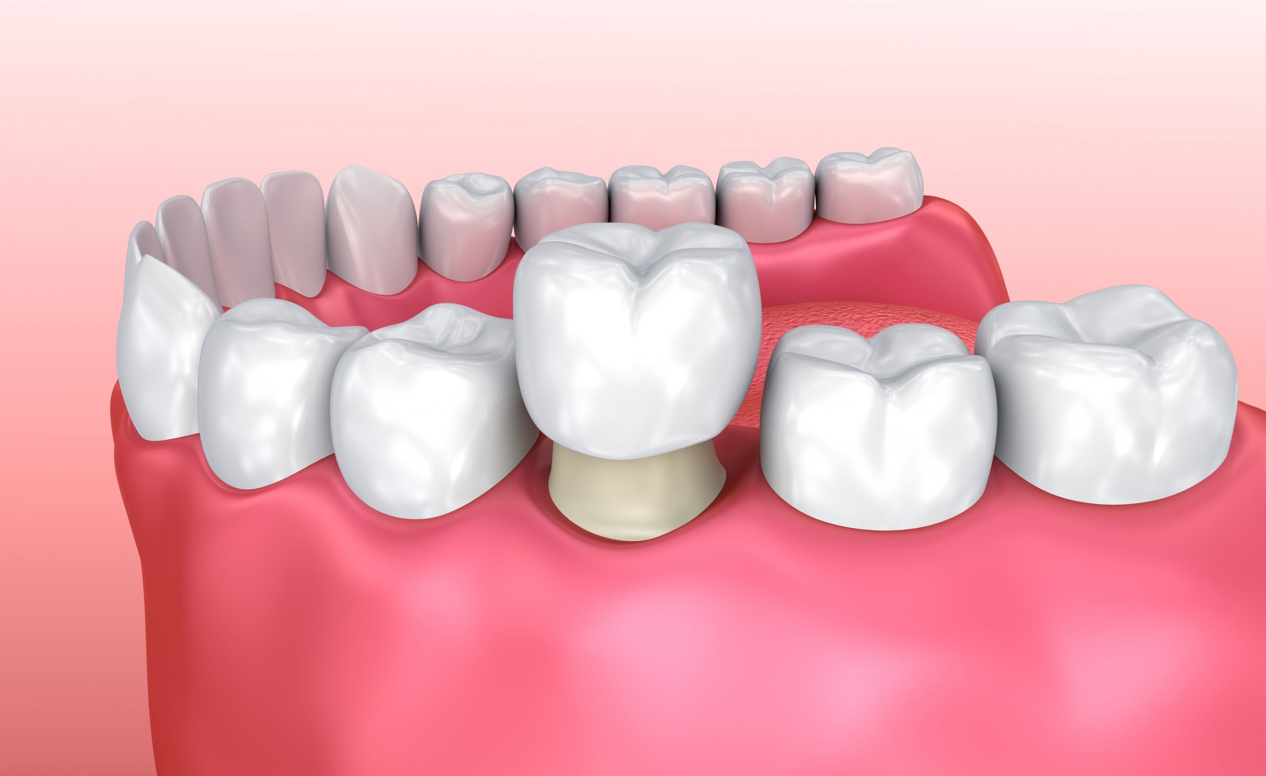 Dental Crowns Tooth Decay and Tooth Trauma Treatments