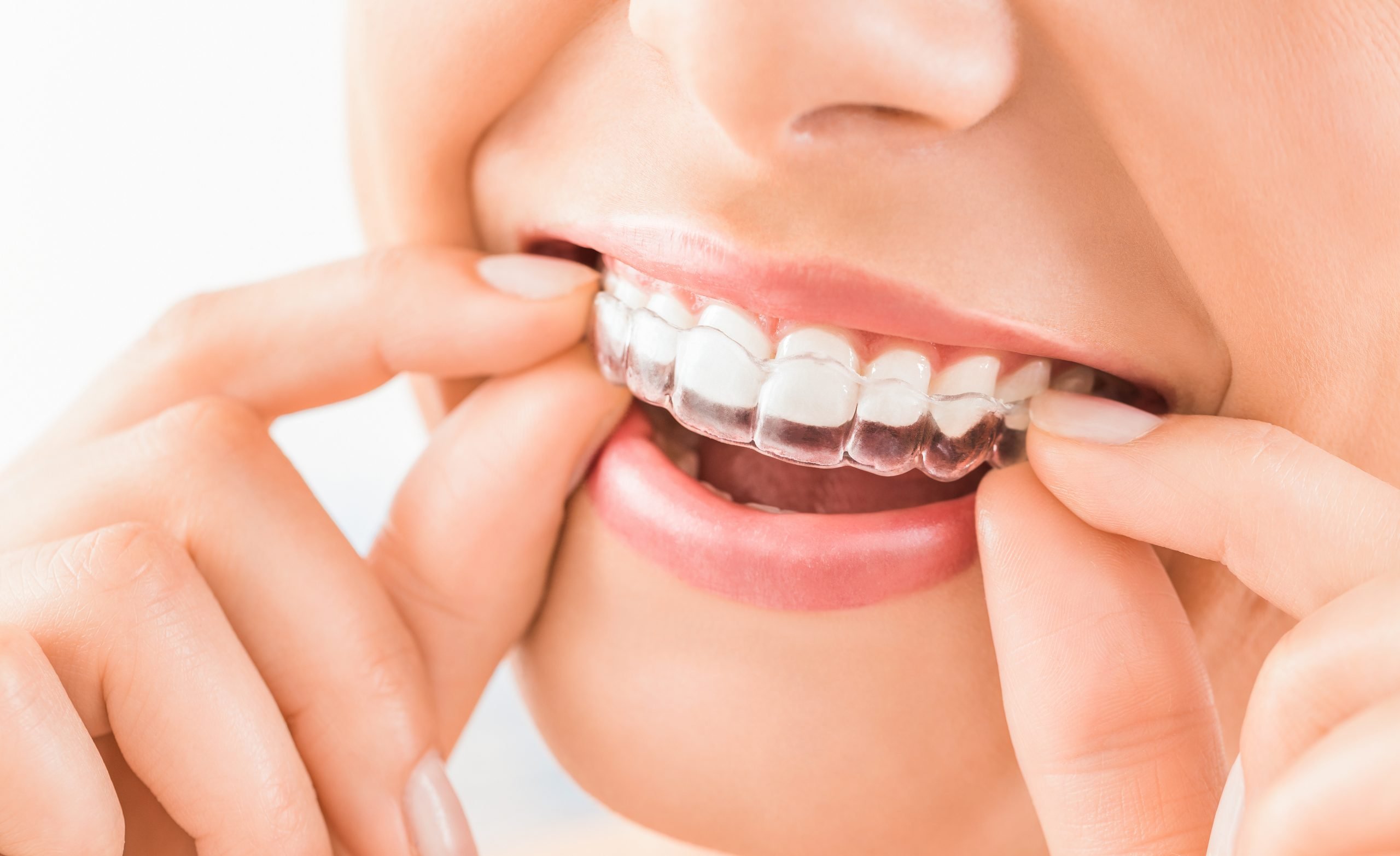 Invisalign Braces Braces for Adults Maine Dental Offices